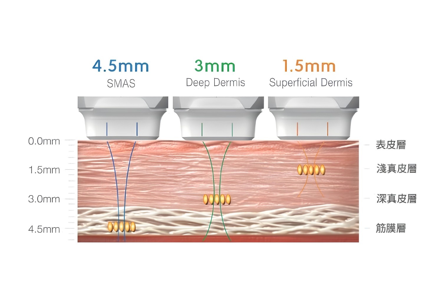 HIFU Energy Layers