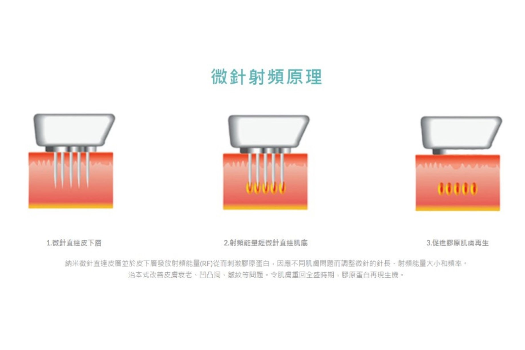 RF射頻機制