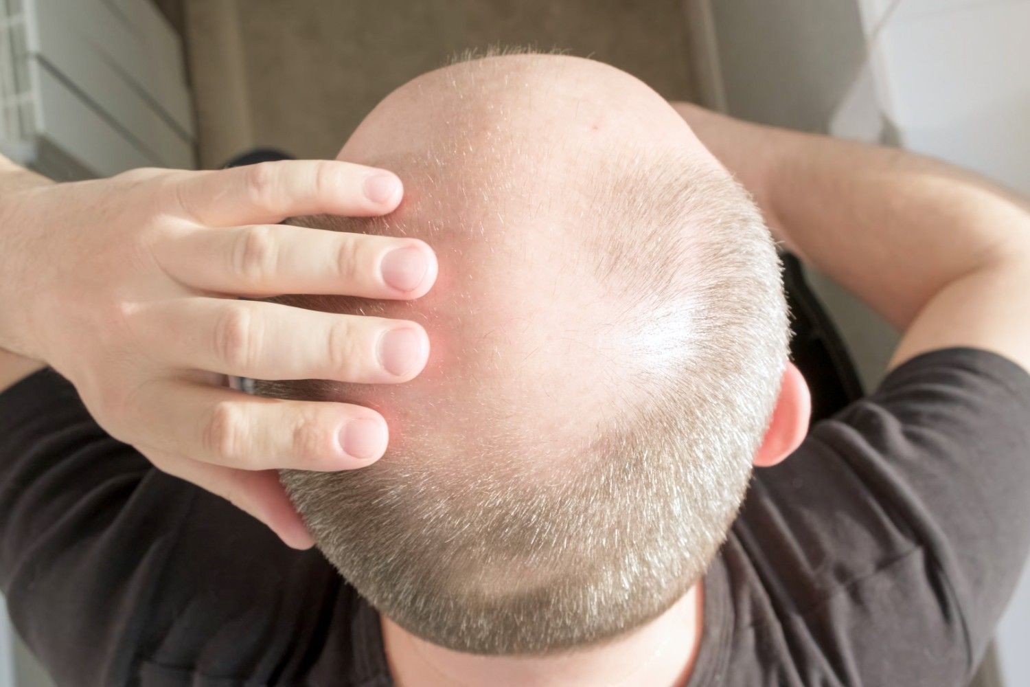 Top of Head Hair Loss
