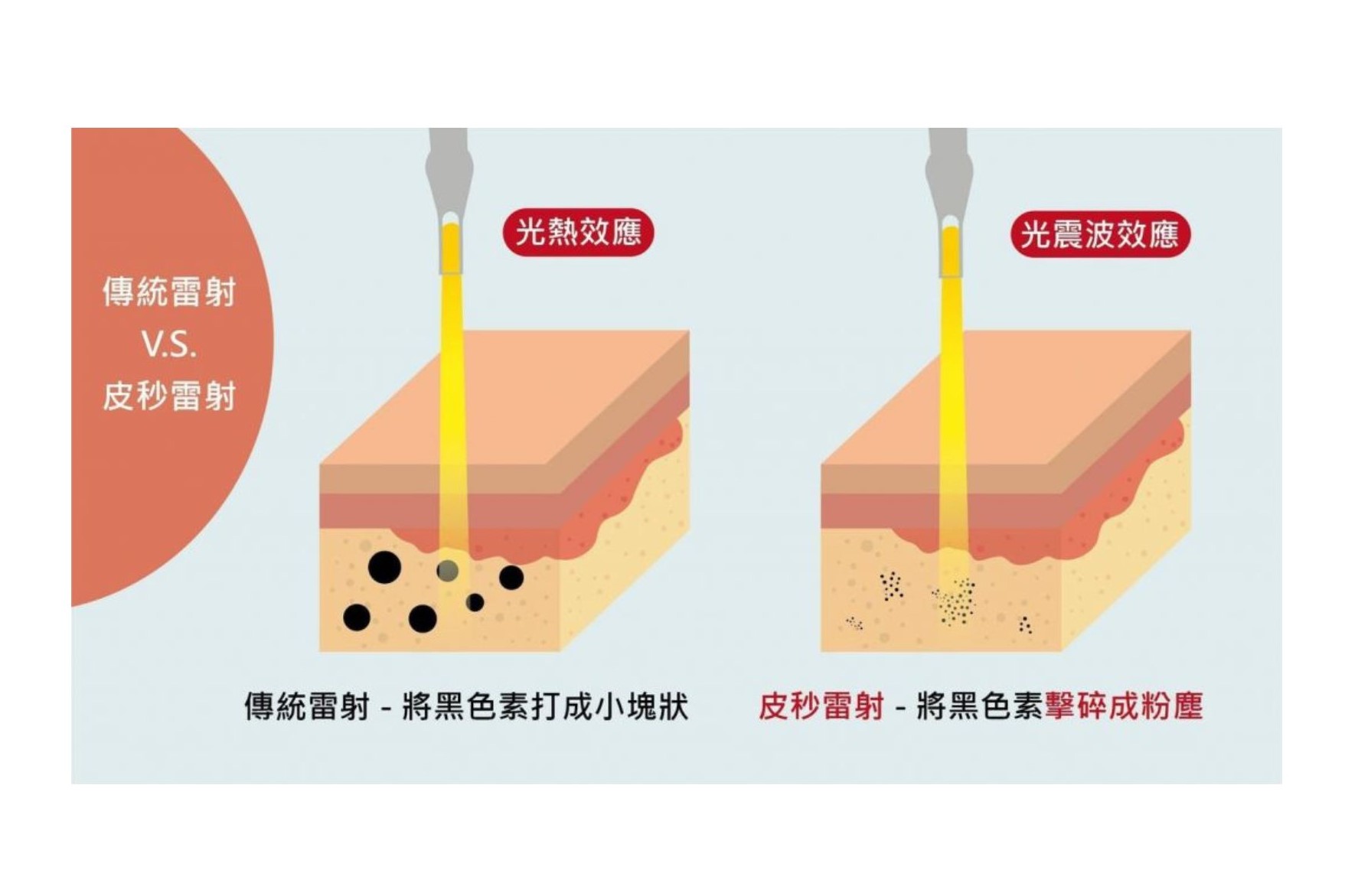 Traditional Laser vs Pico Laser Comparison